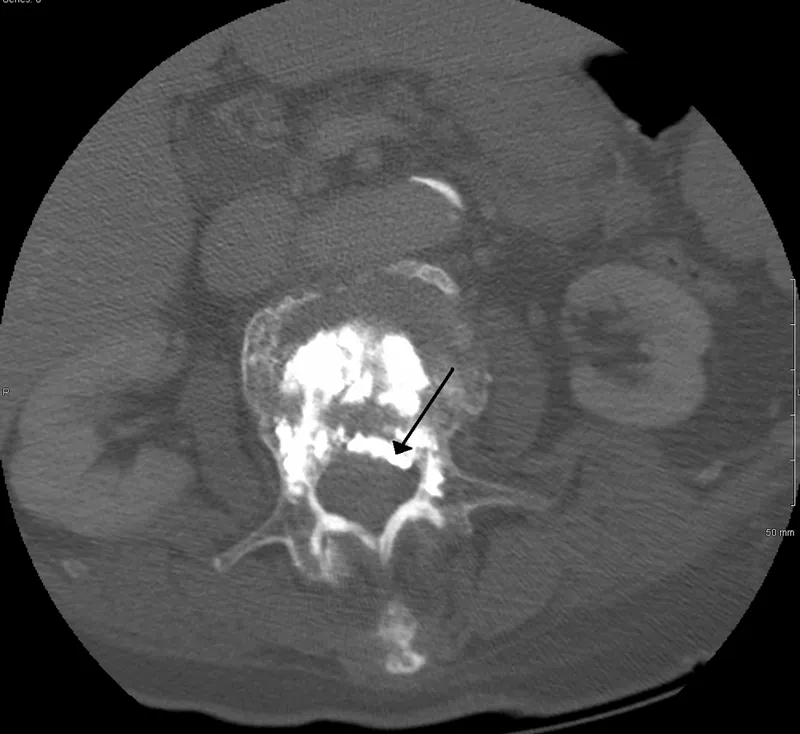 A Ct image of a vertabrae